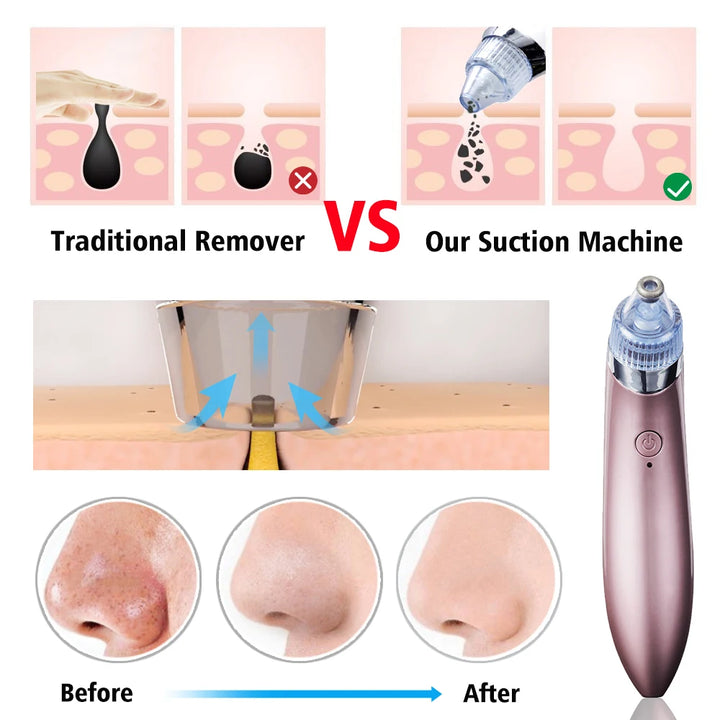 4-in-1 Multifunctional Blackhead Vacuum